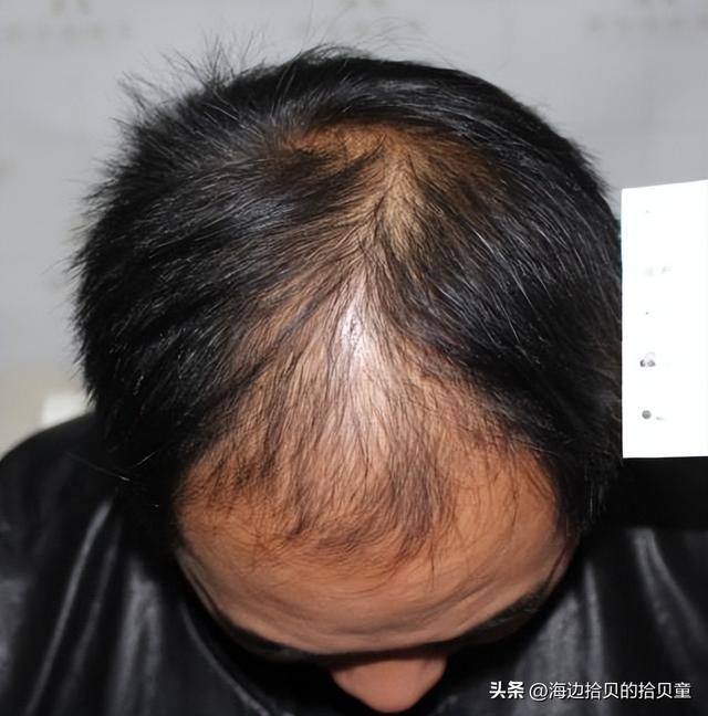 最好？育发液什么牌子最有效果？开元棋牌试玩日本生发液哪个牌子(图2)